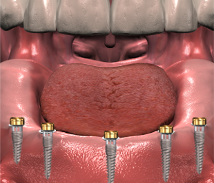 Kiefer mit Miniimplantaten