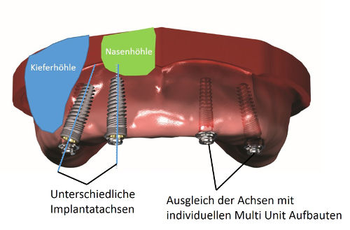 gesetztes Zahnimplantat nach der cz1 Methode