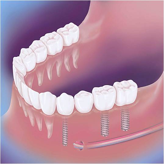 Freiende - gesetzte Implantate