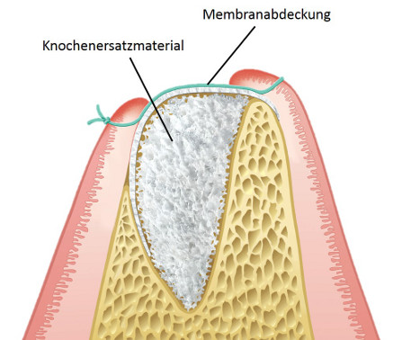 Darstellung Knochenaufbau am Kiefer