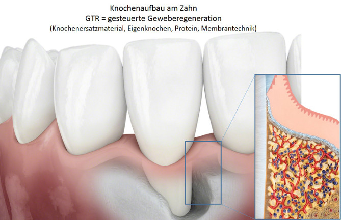 Darstellung Knochenaufbau am Kiefer