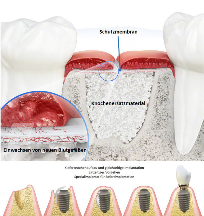 Knochenaufbau und Membrantechnik - Knochenaufbau mit gleichzeitige implantation