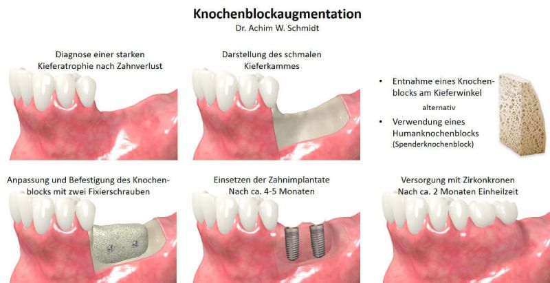 Darstellung Knochenblockaugmntation