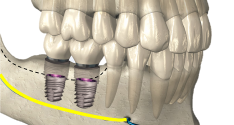 Miniimplantate im Kiefernochen