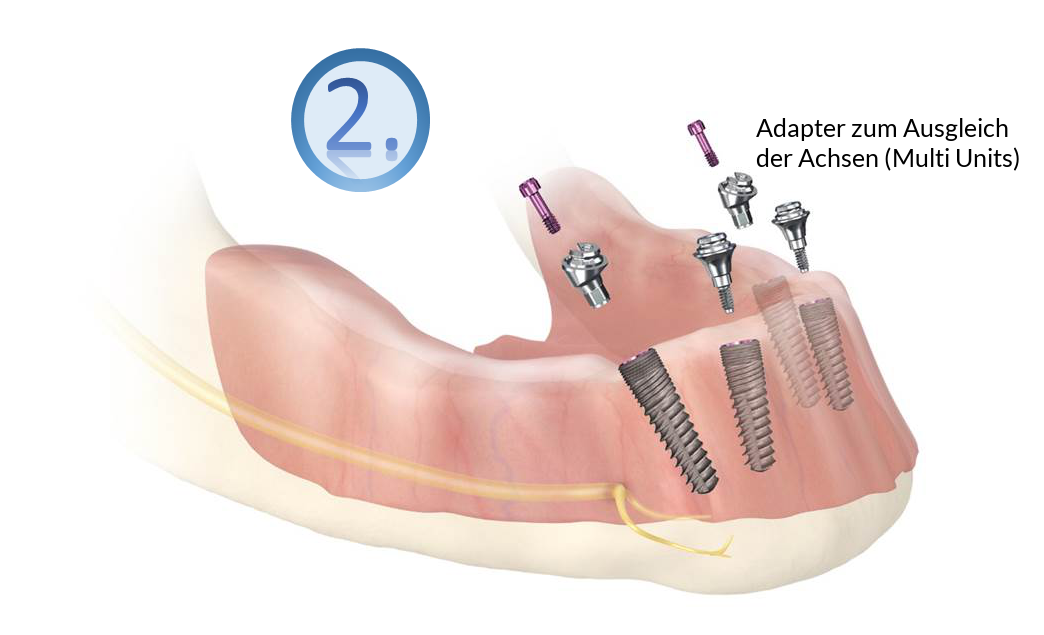 Einsetzen der Multi-Unit-Abutments