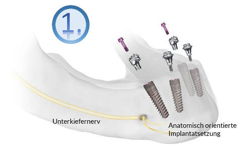 Kiefer mit eingesetzten Implantaten