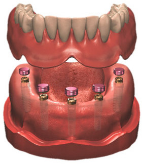 Zahnprothese fixiert mit Implantaten