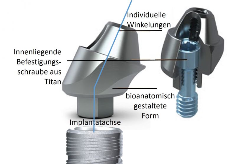 Titan Zahnimplantat in individuellem Winkel