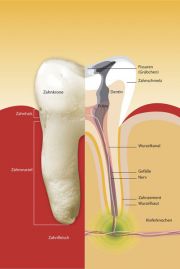 Zahn mit Karies vor der Wurzelbehandlung