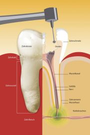 Kariesentfernung bei der Wurzelbehandlung München