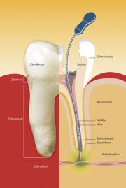 Wurzelbehandlung mit Instrumenten