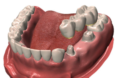 Zahnbrücke zum Ersatz eines verlorenen Zahnes.