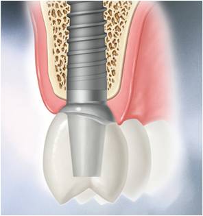 Zahnimplantat Schemazeichnung